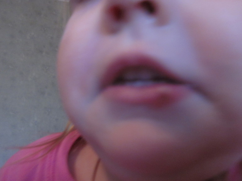 Насосала болячку на губе