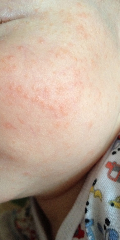 Непонятные высыпания