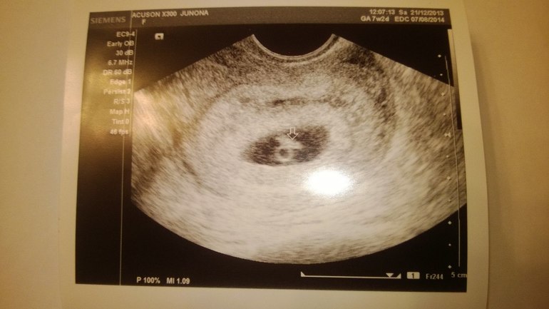 Наше первое УЗИ!))