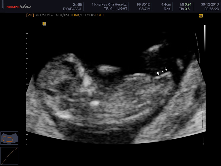 Подержите в сомнениях) узи 12 недель