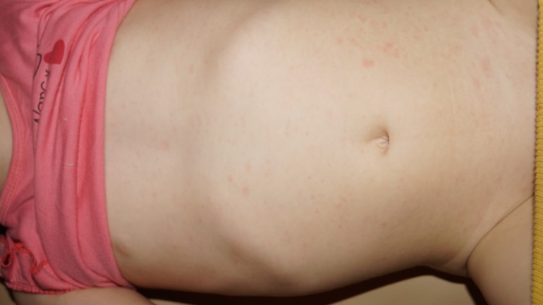 Розеола ли...........??