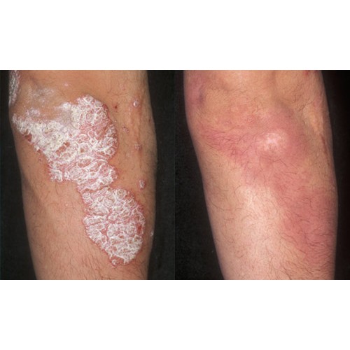 Hydra Heel-Balm от псориаза
