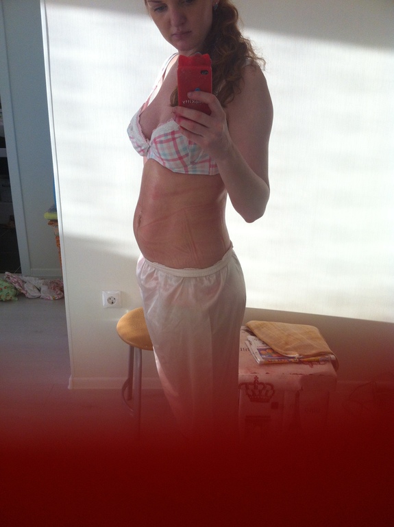 8 дней после ЕР родов. Фото