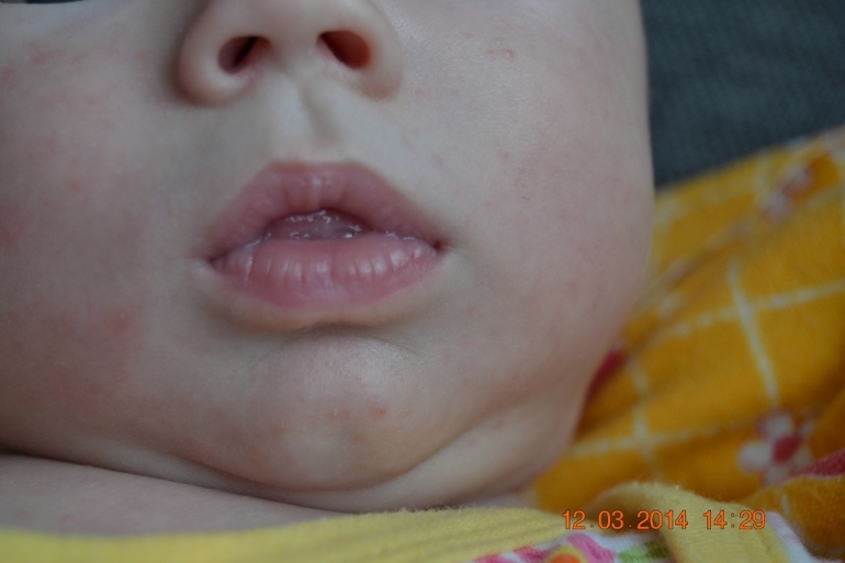 Странная сыпь!