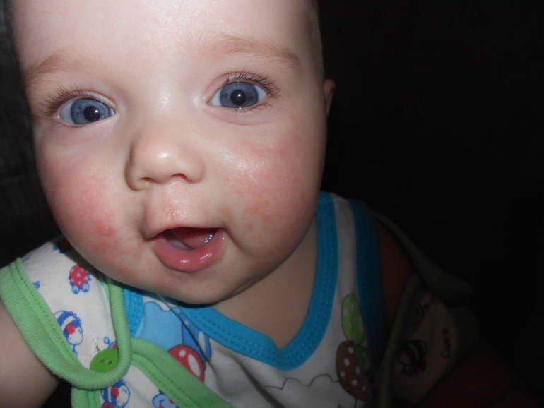 Что за сыпь????