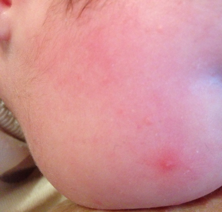 Акне или аллергия?