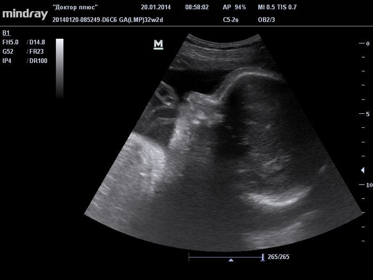 УЗИ 32 недели