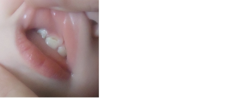 откололась эмаль с  внутренней стороны зубика