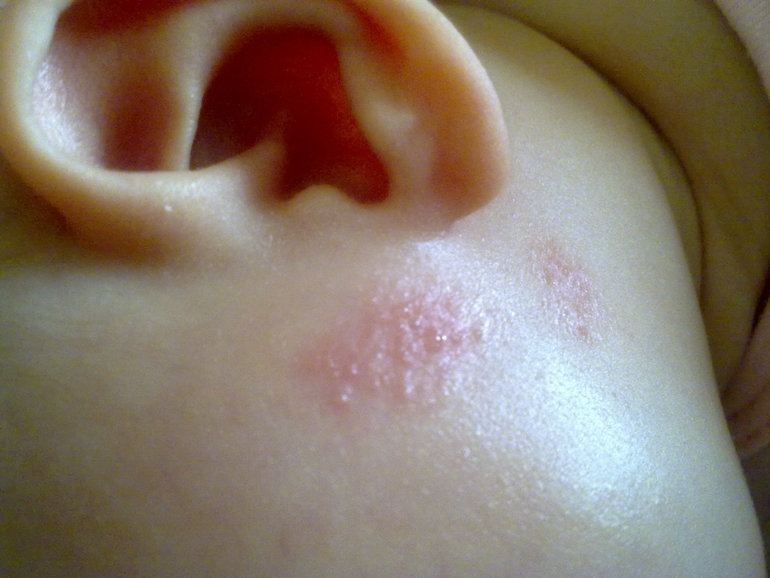 аллергия? фото