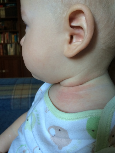 Сыпь. Чем мазать? :(