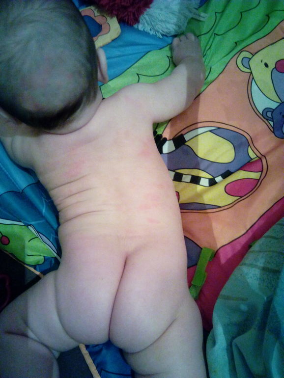 Покраснения на коже