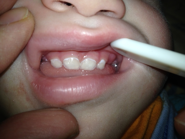 Начальная стадия кариеса? 1 год 7 мес