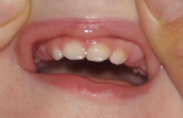 налет или кариес