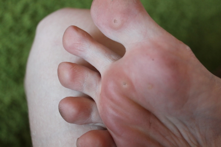 Что это за дефект на ступне?