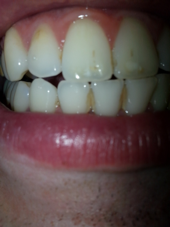 Что с зубами?