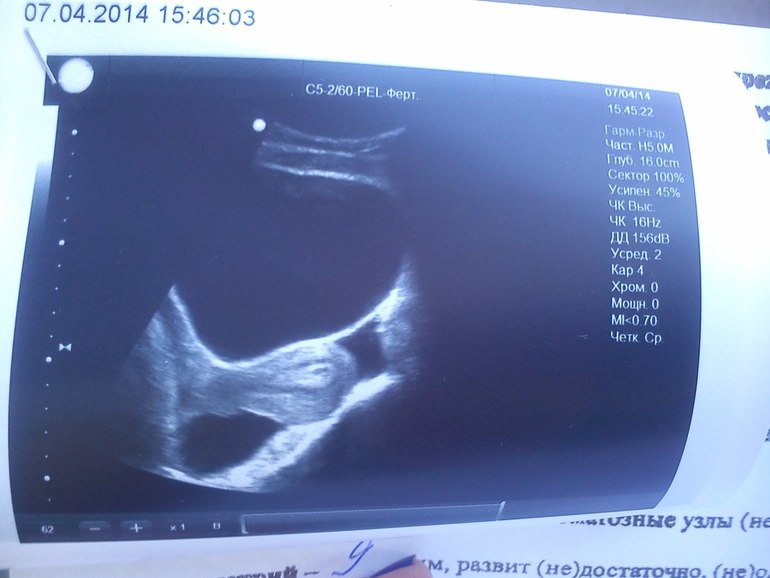 узи малого таза