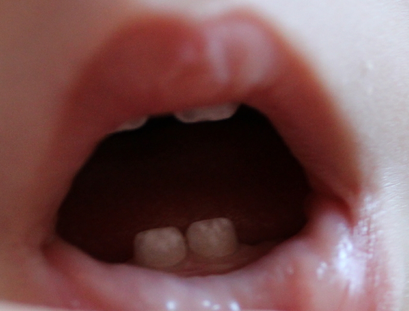 Зубы прорезались с белыми пятнами.