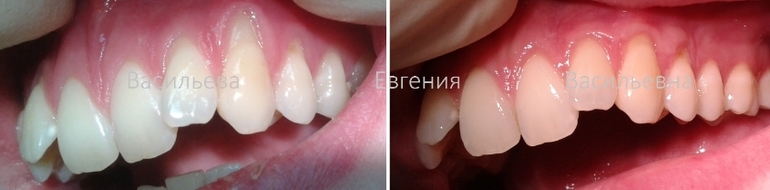 Рецессия десны и чудо-пародонтолог.