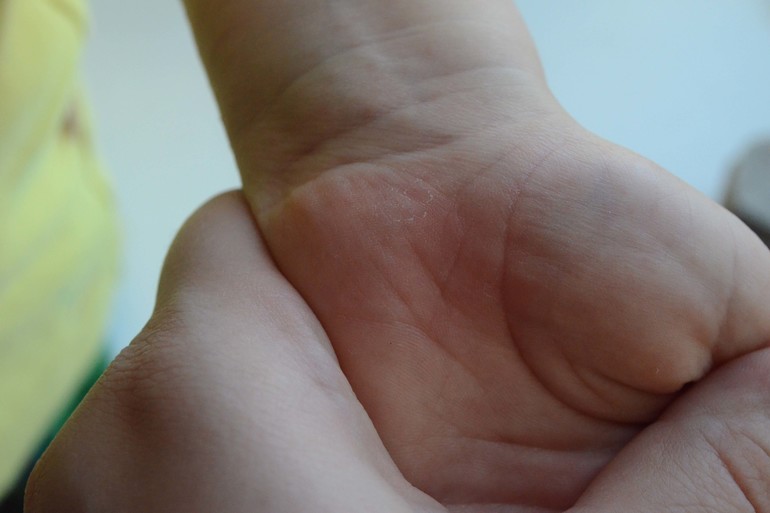 Запуталась, а аллергия ли это?