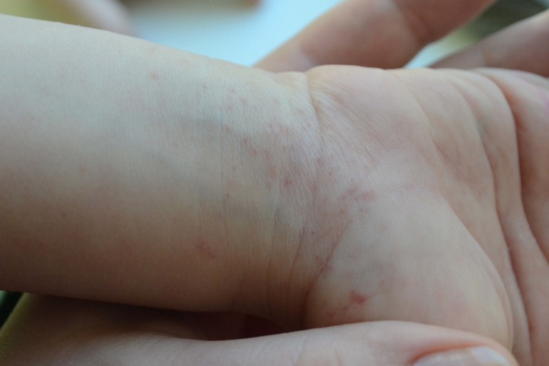 Запуталась, а аллергия ли это?