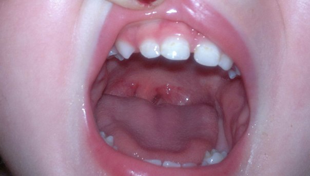 Это кариес или налет?