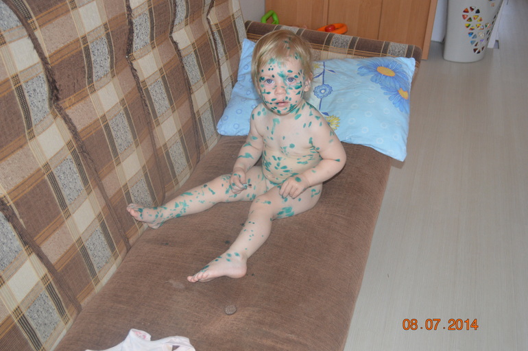 Наша ветрянка