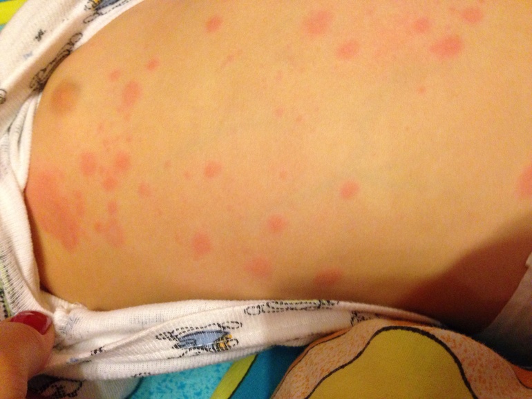 Что за сыпь?