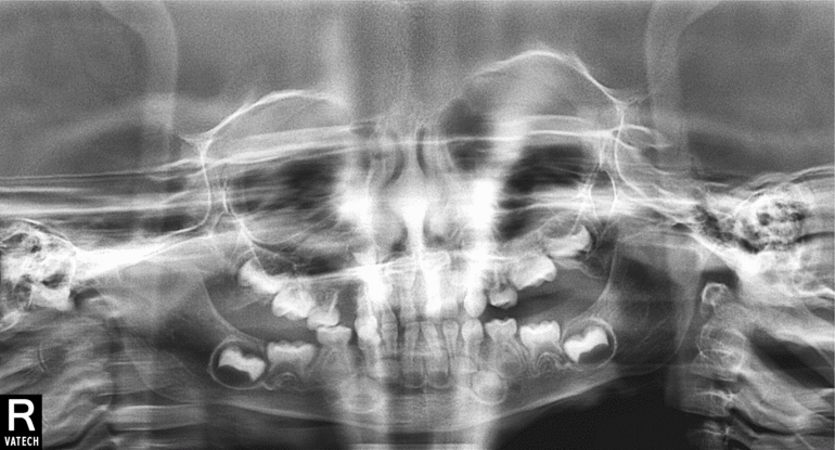 Набухла десна, с синевой. Ребенку 2 года 3 месяца.