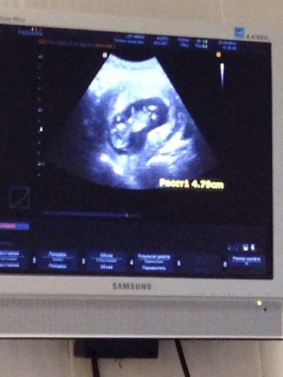 УЗИ в 13,3 нед