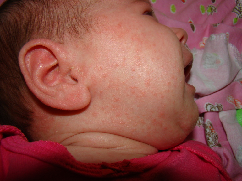 акне, аллергия, диатез или что-то еще?