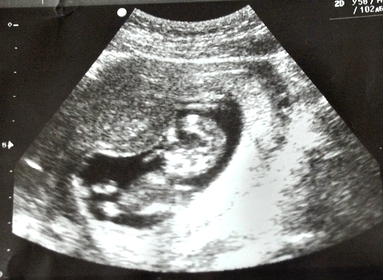 Мой скрининг 12-13 недель)