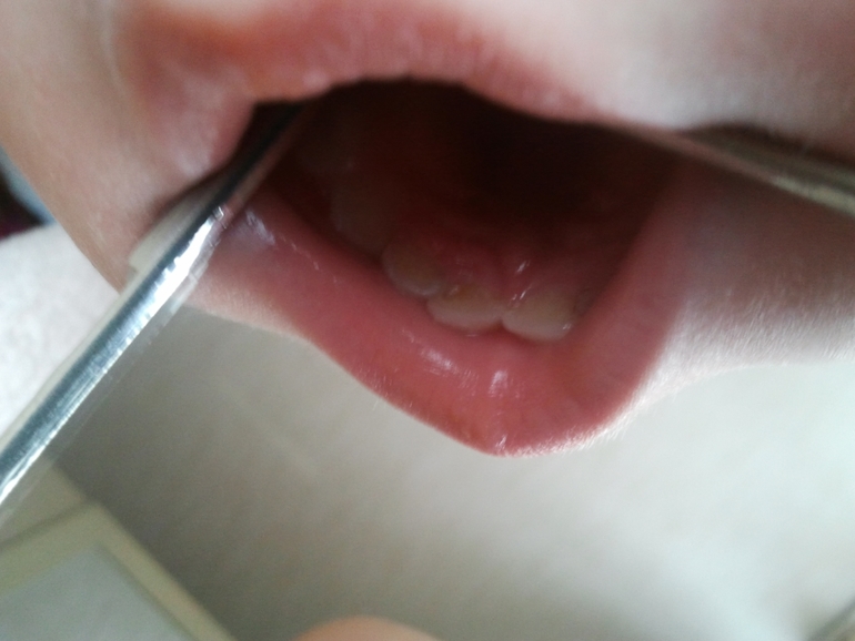 Кариес на передних зубках