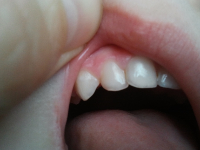 Кариес на передних зубках