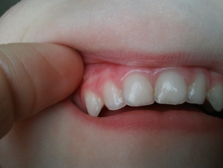 Кариес на передних зубках