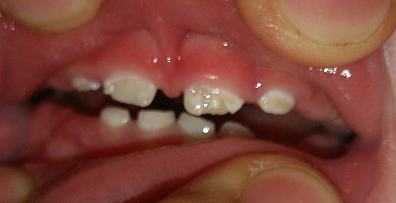 Бутылочный кариес?