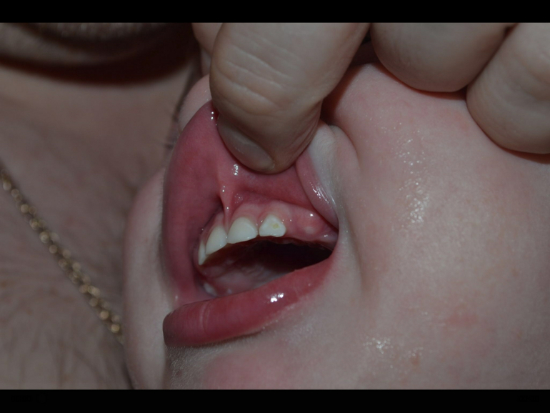 Образовалось пятно на зубе у ребенка.Скорее всего кариес.Как лечить?