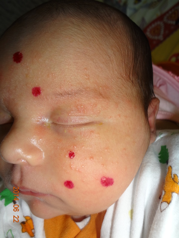 Это АлЛеРгИя или ГоРмОнАлЬнАя сыпь???