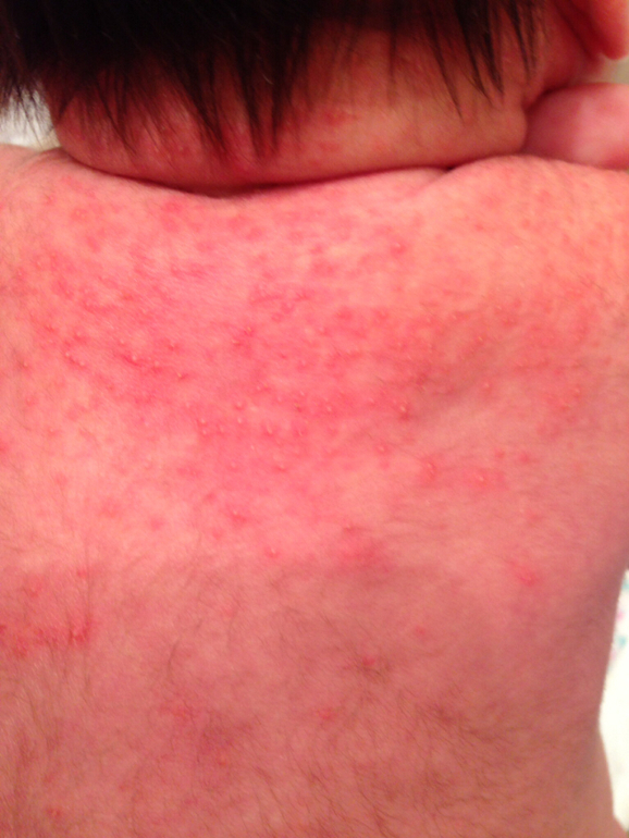 Акне или аллергия ?!