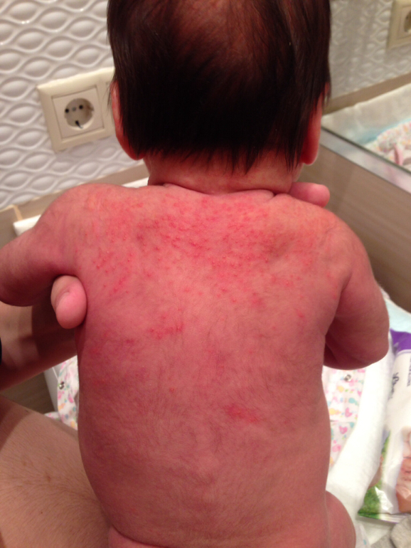 Акне или аллергия ?!