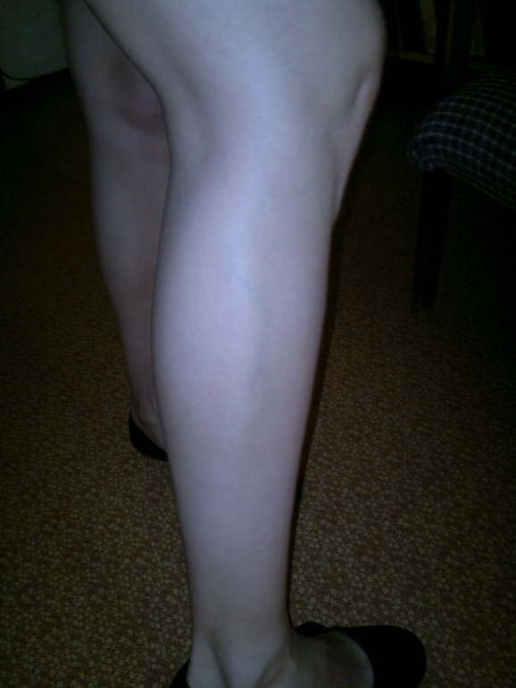 продолжение варикозной паранои.) фотки. ничего нового не увидите...