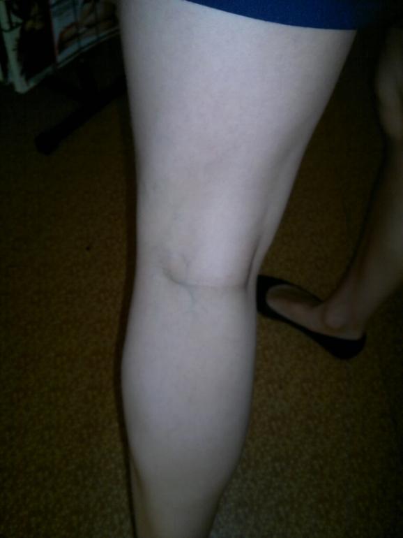 продолжение варикозной паранои.) фотки. ничего нового не увидите...