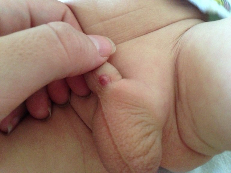 то ли прыщ, то ли нарыв