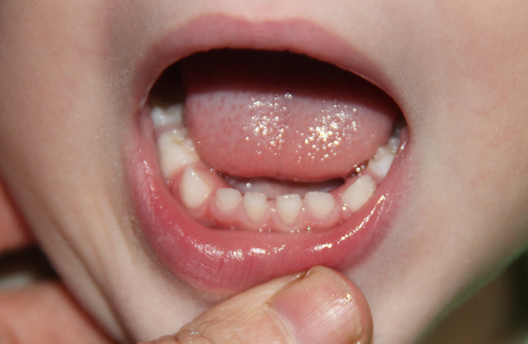 Наша беда с зубками