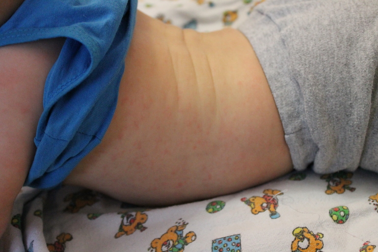 Это розеола?