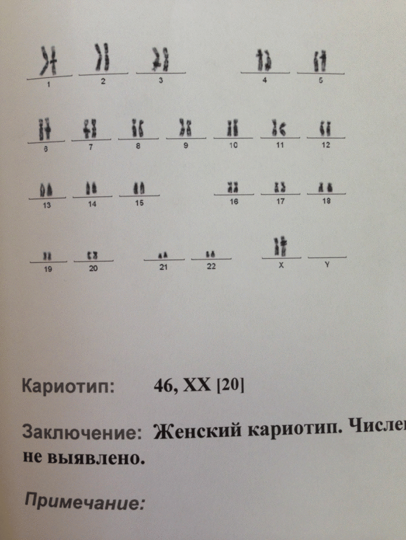 Анализ кариотипа с абберациями