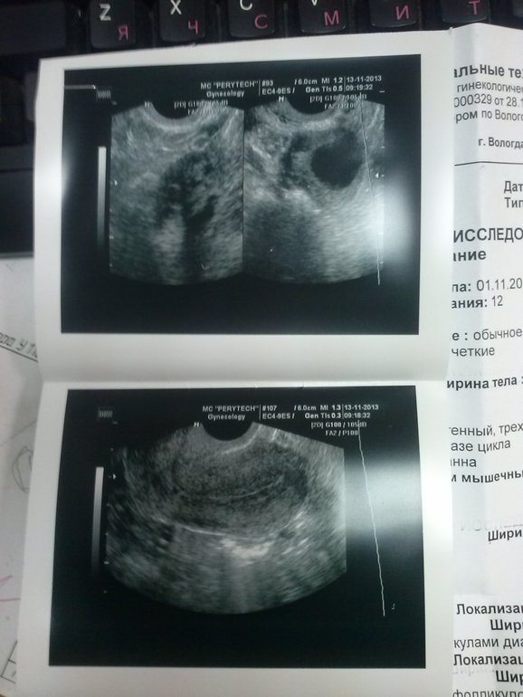 13 день цикла. УЗИ =)