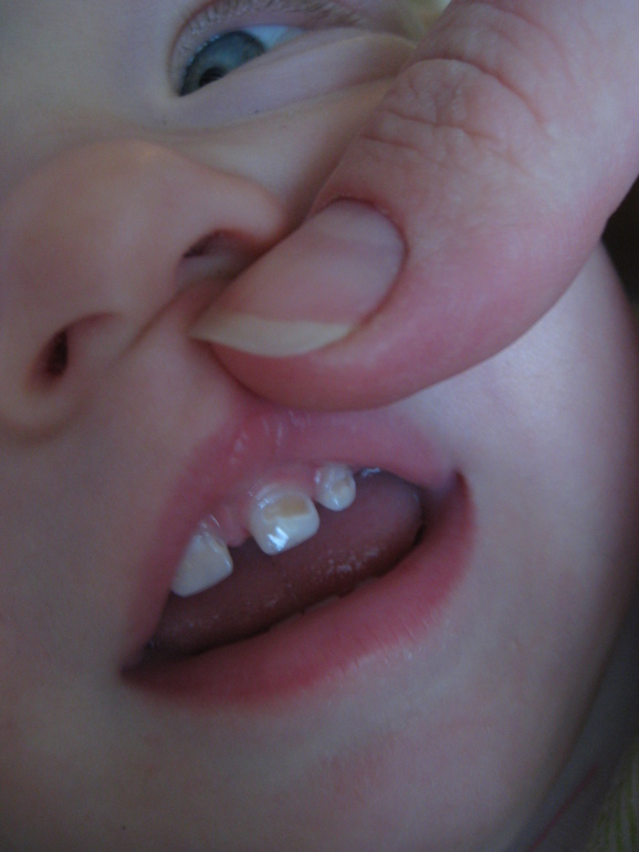 Кариес ! Ребенку нет еще и  года.