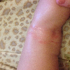нужна помощь.. атомический дерматит?