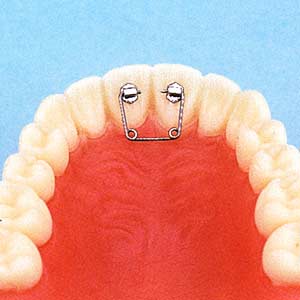 Щели между зубами