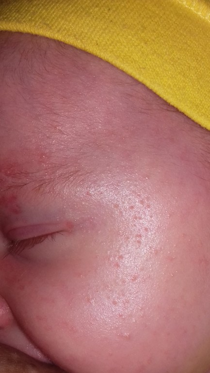 Мелкая сыпь на лице — 29 ответов | форум Babyblog